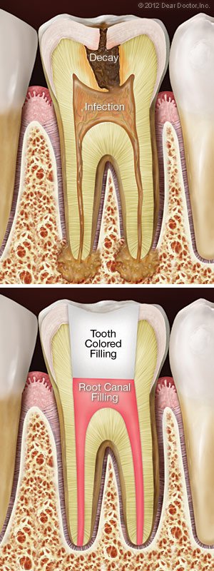 Tooth Colored Filling - Brigham Dental Care 